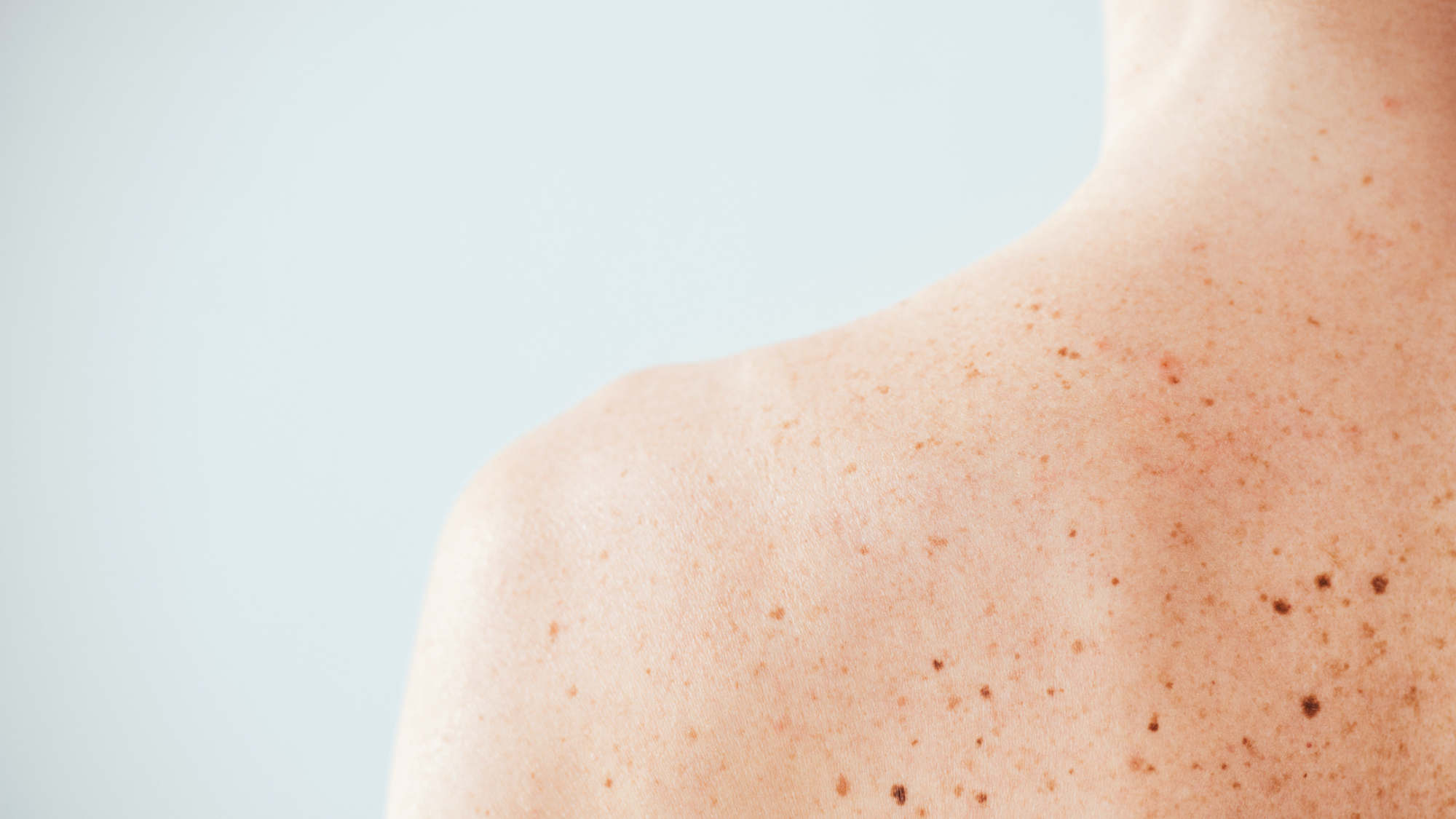 How many moles is deemed a high risk of skin cancer or melanoma?