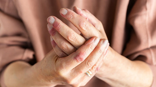 Someone's hands holding each other with a skin condition.