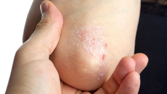 Solbari blog: How can I stop psoriasis flare ups?