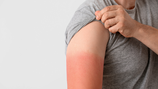 Solbar blog: How many sunburns does it take to get skin cancer?