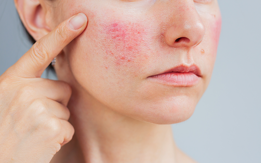 How UPF 50+ Sun Protection Can Help Alleviate Rosacea