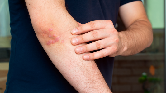 Solbari helping people living with psoriasis