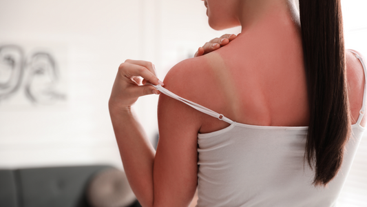 Solbari blog: Why does sunburn hurt?
