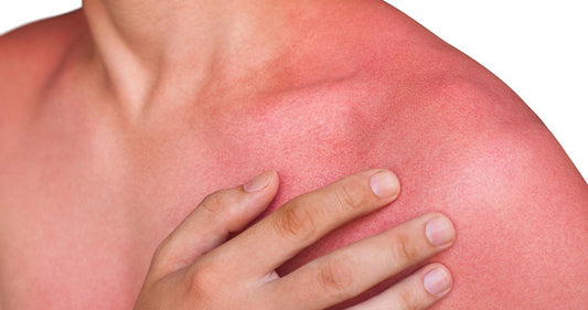 Medications which cause photosensitivity